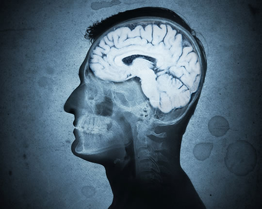 Drug Reverses Alzheimer’s Memory Loss, Study Finds