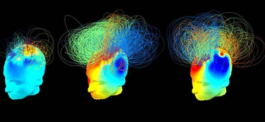 Consciousness in Vegetative Patients Thought Beyond Hope Revealed by Active Brain Networks